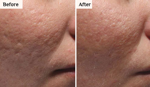 morpheus8 before after neck